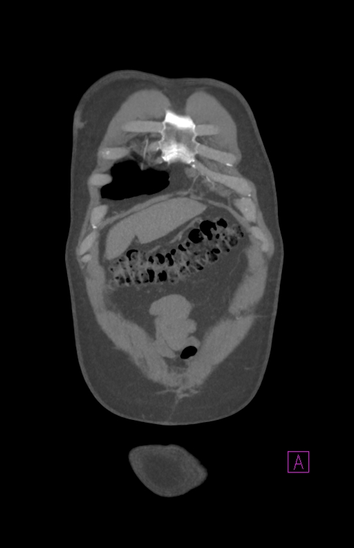 Aortectomy and axillary-bifemoral bypass (Radiopaedia 28303-28545 C 14).jpg