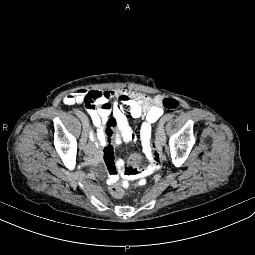 Aortic aneurysm and Lemmel syndrome (Radiopaedia 86499-102554 Axial C+ delayed 66).jpg