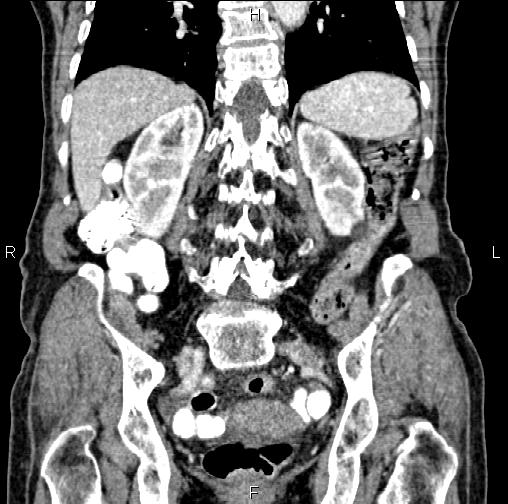 File:Aortic aneurysm and Lemmel syndrome (Radiopaedia 86499-102554 C 46).jpg