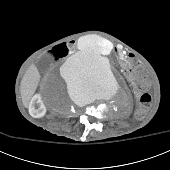 File:Aortic aneurysm with spinal destruction (Radiopaedia 42301-45410 A 47).jpg