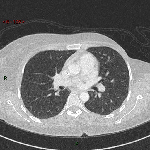 Aortic arch origin of left vertebral artery (Radiopaedia 51520-57286 Axial lung window 108).jpg