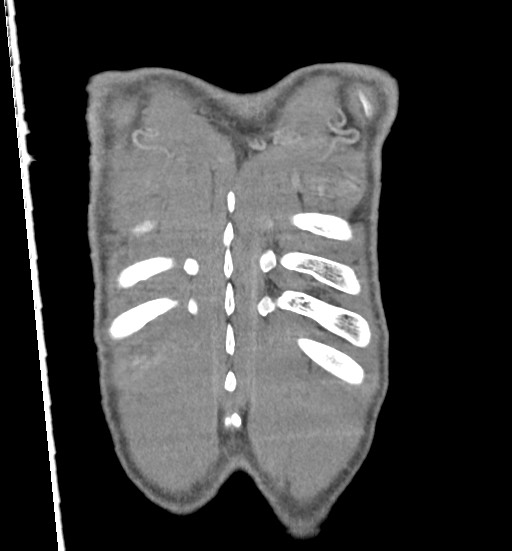 Aortic coarctation with aneurysm (Radiopaedia 74818-85828 C 113).jpg