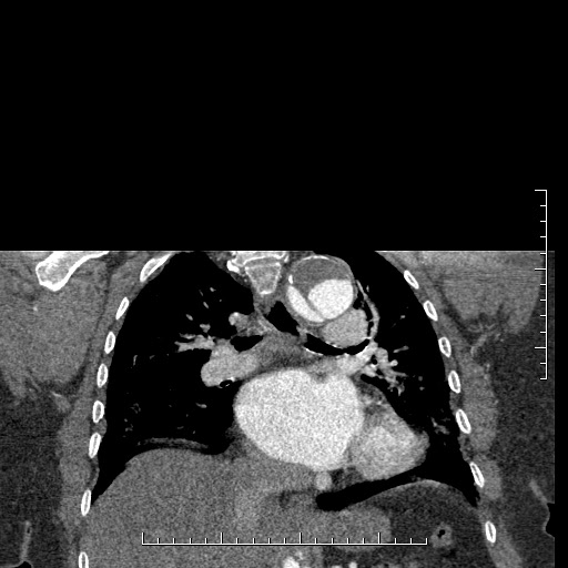 Aortic dissection- Stanford A (Radiopaedia 35729-37268 E 22).jpg