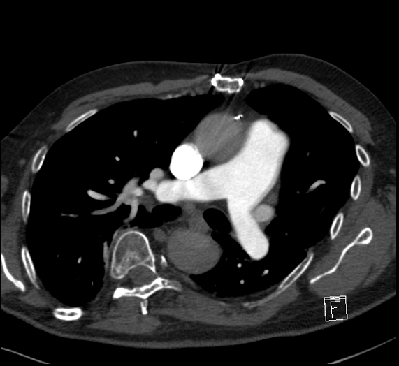 File:Aortic dissection (CTPA) (Radiopaedia 75506-86751 Axial C+ CTPA 64).jpg