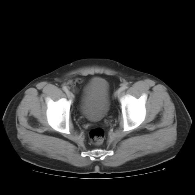 Aortic dissection (Radiopaedia 44411-48061 C 100).jpg