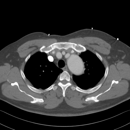 Aortic dissection (Radiopaedia 50763-56234 A 6).png