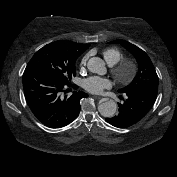 Aortic dissection (Radiopaedia 57969-64959 A 167).jpg