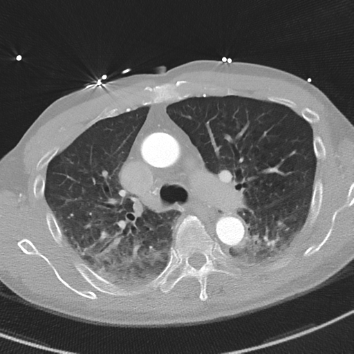 File:Aortic dissection - DeBakey type II (Radiopaedia 64302-73082 Axial lung window 23).png