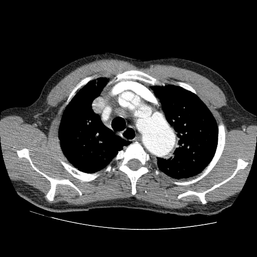 File:Aortic dissection - Stanford A -DeBakey I (Radiopaedia 28339-28587 B 5).jpg