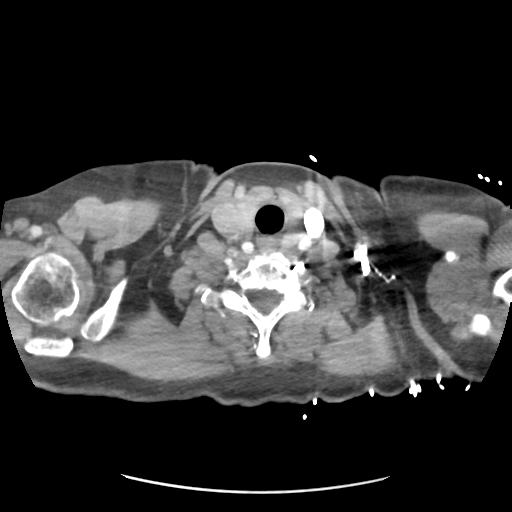 File:Aortic dissection - Stanford type B (Radiopaedia 50171-55512 A 1).png