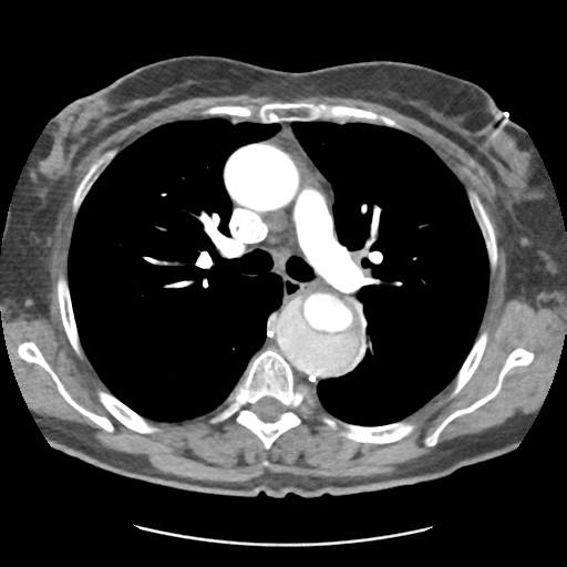 Aortic dissection - Stanford type B (Radiopaedia 50171-55512 A 20).png