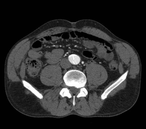 Aortic dissection - Stanford type B (Radiopaedia 73648-84437 A 193).jpg