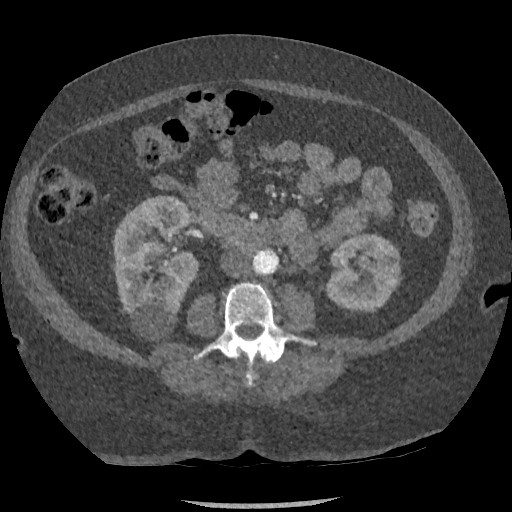 Aortic dissection - Stanford type B (Radiopaedia 88281-104910 A 122).jpg