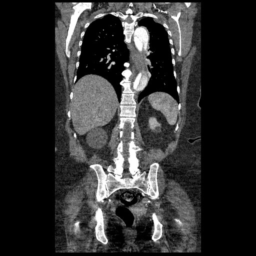 File:Aortic dissection - Stanford type B (Radiopaedia 88281-104910 B 60).jpg