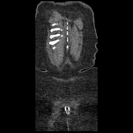 File:Aortic dissection - Stanford type B (Radiopaedia 88281-104910 B 90).jpg