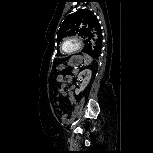 File:Aortic dissection - Stanford type B (Radiopaedia 88281-104910 C 63).jpg
