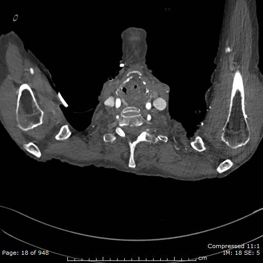 Aortic dissection with extension into aortic arch branches (Radiopaedia 64402-73204 B 18).jpg