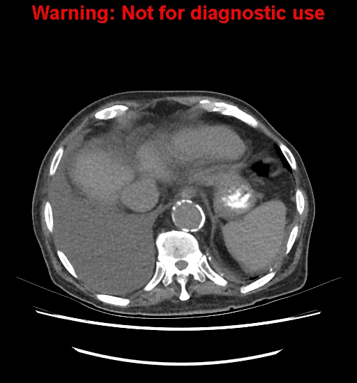File:Aortic graft infection (Radiopaedia 44979-48907 Axial non-contrast 20).jpg