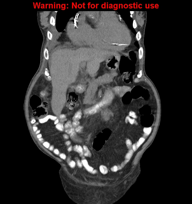 Aortic graft infection (Radiopaedia 44979-48907 non-contrast 15).jpg