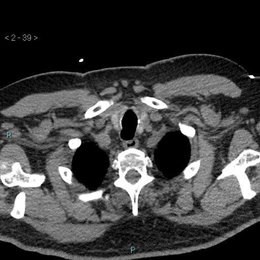 Aortic intramural hematoma (Radiopaedia 48463-53380 Axial non-contrast 17).jpg