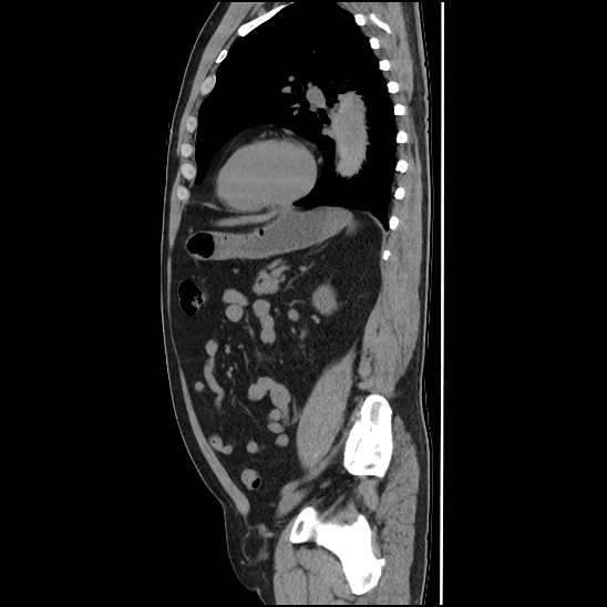 File:Aortic intramural hematoma (type B) (Radiopaedia 79323-92387 G 36).jpg
