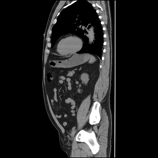 Aortic intramural hematoma (type B) (Radiopaedia 79323-92387 G 37).jpg