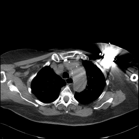 Aortic intramural hematoma with dissection and intramural blood pool (Radiopaedia 77373-89491 Axial non-contrast 25).jpg