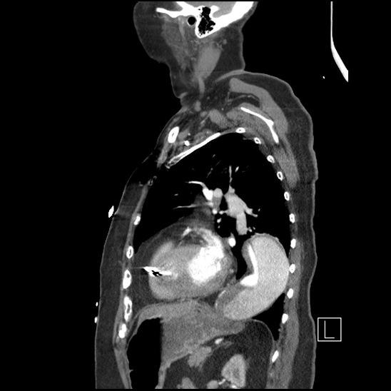 Aortic intramural hematoma with dissection and intramural blood pool (Radiopaedia 77373-89491 D 60).jpg