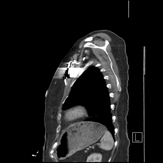 Aortic intramural hematoma with dissection and intramural blood pool (Radiopaedia 77373-89491 D 74).jpg