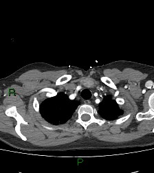 Aortic valve endocarditis (Radiopaedia 87209-103485 C 12).jpg
