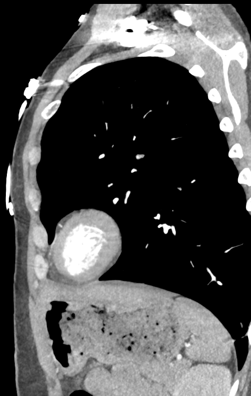Aortic valve non-coronary cusp thrombus (Radiopaedia 55661-62189 C+ arterial phase 5).png