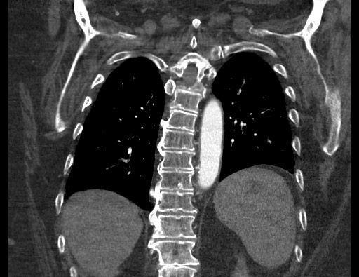 Aortoesophageal fistula with endovascular repair (Radiopaedia 73781-84592 Coronal C+ CTPA 101).jpg