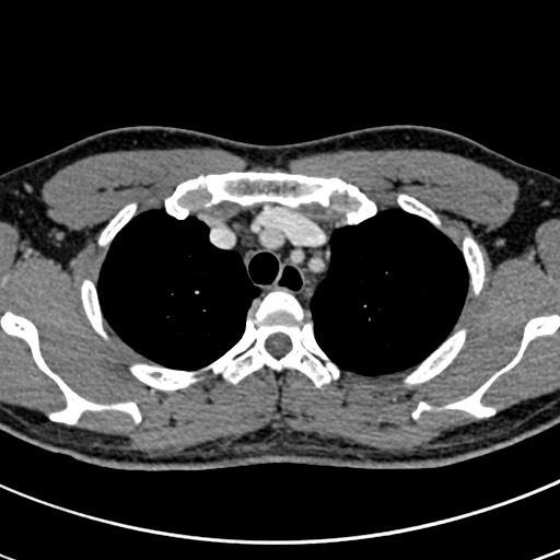 Apical lung mass mimic - neurogenic tumor (Radiopaedia 59918-67521 A 17).jpg