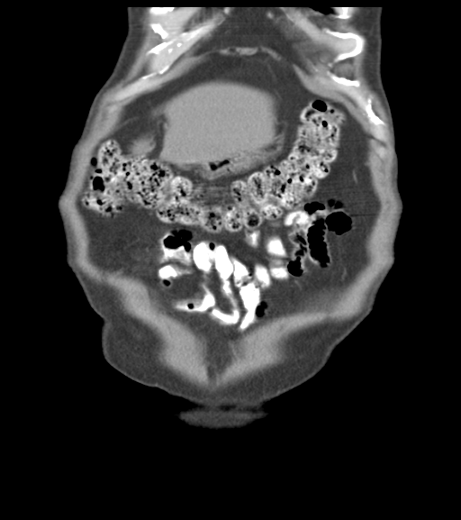 File:Appendiceal abscesses (Radiopaedia 50999-56542 Coronal non-contrast 13).png