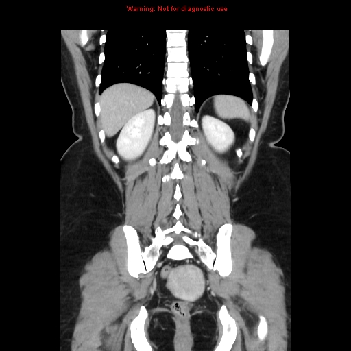 File:Appendiceal mucinous cystadenoma (Radiopaedia 8263-9111 B 57).jpg