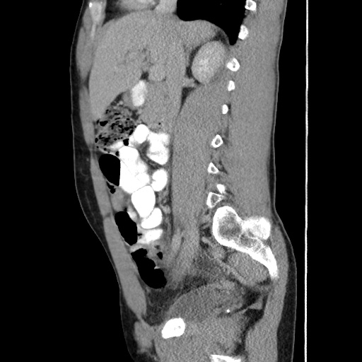 Appendicitis complicated by post-operative collection (Radiopaedia 35595-37114 C 31).jpg