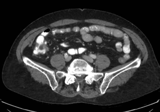 Appendicitis due to chicken fibula (Radiopaedia 74314-85198 A 12).jpg