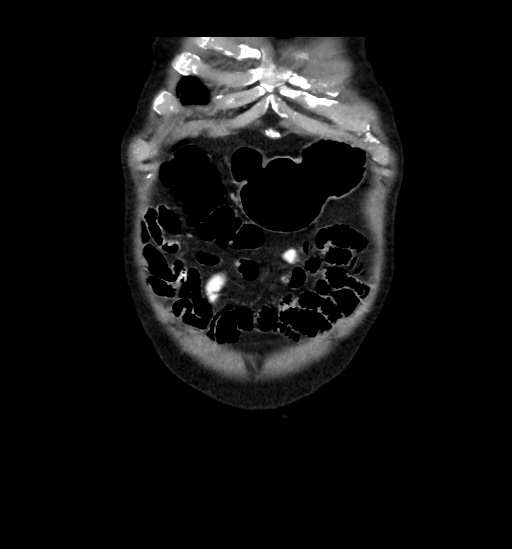 File:Appendicitis with localized perforation and abscess formation (Radiopaedia 49035-54130 B 6).jpg