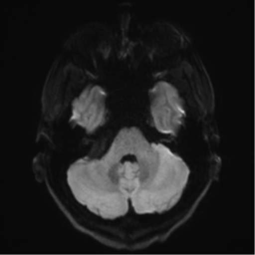 Arachnoid cyst - cerebellopontine angle (Radiopaedia 59689-67083 Axial DWI 45).png