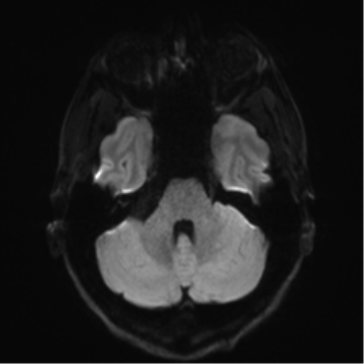 File:Arachnoid cyst - cerebellopontine angle (Radiopaedia 59689-67083 Axial DWI 46).png
