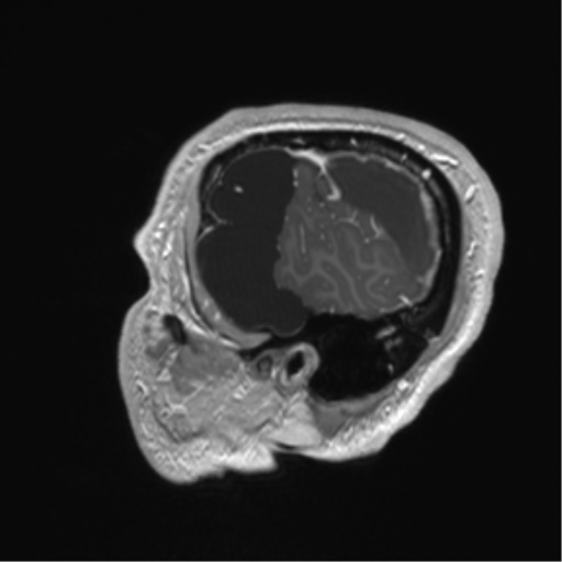 Arachnoid cyst with subdural hematoma (Radiopaedia 85892-101743 Sagittal T1 C+ 15).png