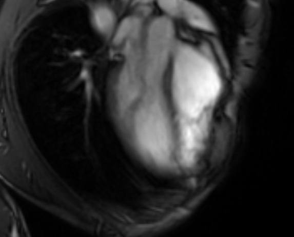 Arrhythmogenic right ventricular cardiomyopathy (Radiopaedia 69564-79464 4ch cine 31).jpg