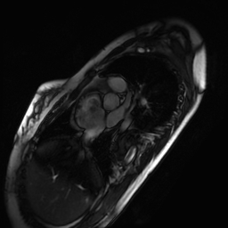 Arrhythmogenic right ventricular cardiomyopathy (Radiopaedia 87505-103850 short axis Cine SSFP 266).jpg