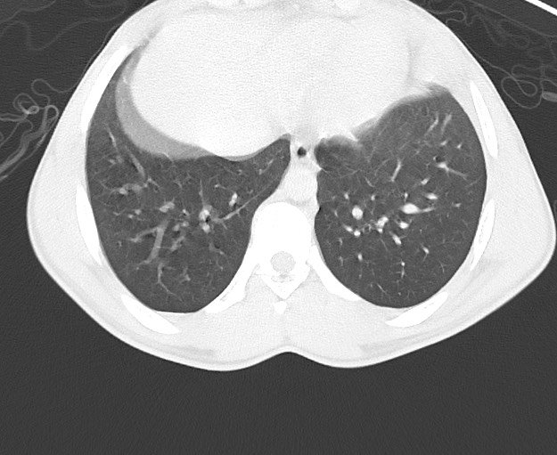 File:Arrow injury to the chest (Radiopaedia 75223-86321 Axial lung window 70).jpg