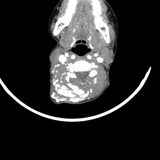 Arteriovenous malformation of the neck (Radiopaedia 53935-60062 A 34).jpg