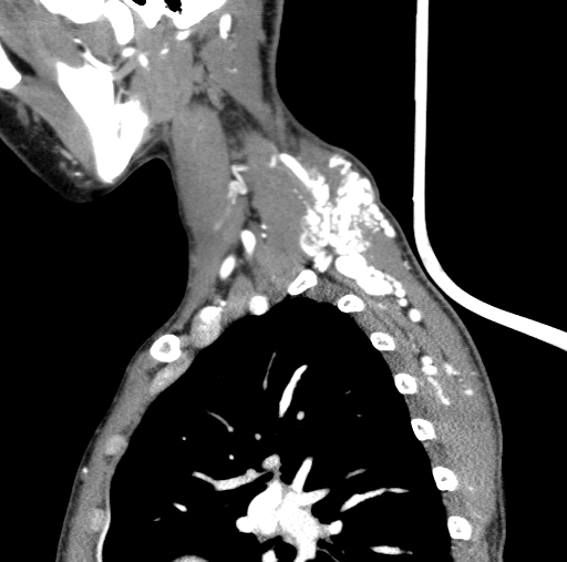 File:Arteriovenous malformation of the neck (Radiopaedia 53935-60062 C 24).jpg
