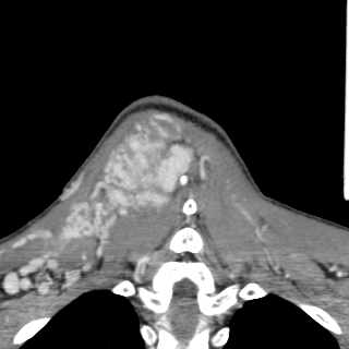 Arteriovenous malformation of the neck (Radiopaedia 53935-60062 D 48).jpg