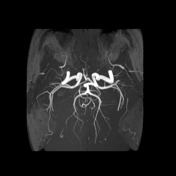 Artery of Percheron infarct (Radiopaedia 40966-43676 F 41).jpg