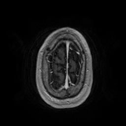 Artery of Percheron infarction (Radiopaedia 27975-28230 Axial T1 C+ fat sat 92).jpg