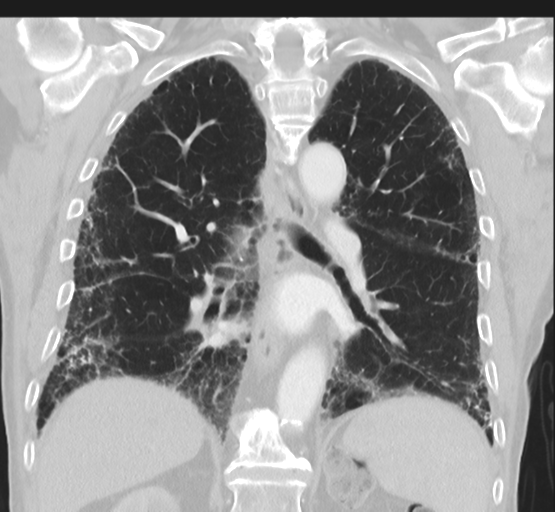 Asbestosis (Radiopaedia 56192-62864 Coronal lung window 33).png